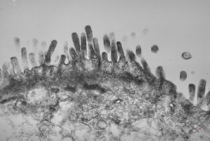 celiakia celiakia